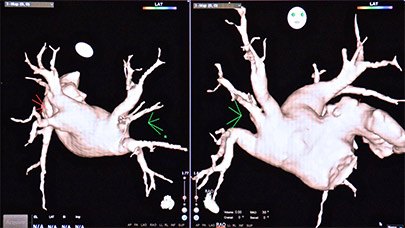 Cardiac Electrophsiology