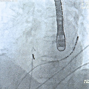 Transoesophageal Echocardiograms (TOE)